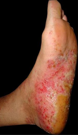 Plantar lesions before starting treatment with ustekinumab.