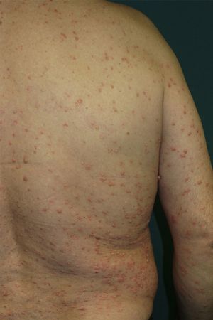 Back covered with small psoriasis plaques on which warts had developed.