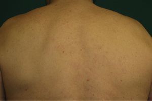 Clearance of both the warts and psoriasis after treatment with acitretin 35mg/d and narrowband UV-B phototherapy.