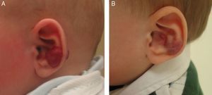 A, Four-month-old boy with a focal hemangioma on the auricle. B, After treatment with 2mg/kg/d of oral propranolol, resolution was nearly complete after 4 months.