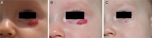 A, Superficial hemangioma on the lower eyelid of a 4.5-month-old baby girl. Twice-daily application of 0.5% timolol was prescribed. B, Response began to be evident at 2 weeks, and C, was remarkable at 6 months, when the hemangioma had almost fully disappeared.