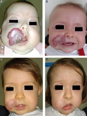 A, The hemangioma of this 2-month-old baby girl affected the parotid, cheek, and lip, with associated ulceration. B and C, Clinical response was highly satisfactory after 1 and 3 months of treatment with oral propranolol (2mg/kg/d). D, At the end of 9 months of treatment, there is redundant, atrophied tissue and slight deformity of the facial structure that can be treated with laser surgery.