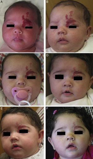 A, Infant girl at 6 weeks with a rapidly growing segmental hemangioma on the forehead and eyelid. Ptosis was marked and progressive. On magnetic resonance the position of the entire eye could be seen to be shifted due to retrobulbar growth of the hemangioma. Oral propranolol treatment was started at a dosage of 2mg/kg/d. B, Improvement could already be seen at 72hours. C-F, Under this treatment the clinical course was highly satisfactory at 1.5, 3, 4, and 6 months, respectively.