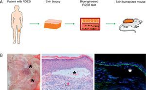 Development of humanized models of rare skin diseases. (A) Human skin regenerated in immunodeficient mice from cells obtained from patients with recessive dystrophic epidermolysis bullosa (RDEB) reproduces the phenotype of this severe disease (B) as evidenced clinically and histologically by the presence of blisters (hematoxylin–eosin, ×20) (as indicated by asterisks) and the presence of type VII collagen in the roof of the blisters (type VII collagen, ×20).