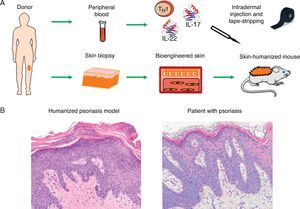 Modeling of prevalent skin diseases. (A) Humanized model of psoriasis based on intradermal injection in regenerated human skin of subpopulations of T-cells differentiated from a T 1 phenotype by the injection of TH17 type cytokines (IL-17 and IL-22) followed by mechanical removal or disruption of the stratum corneum by tape-stripping. (B) The model recapitulates the key phenotypic characteristics of the disease, such as elongation and fusion of the rete ridges, parakeratosis, increased vascularity, and dilated capillaries, among others (hematoxylin–eosin ×20). IL indicates interleukin.
