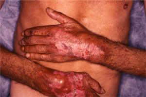 Patient #1. Erythematous whitish scar-like lesions with several erosions and surrounded by brown, parchment-like skin. Note the sharp demarcation between the lesions and the normal skin in the wrist area.