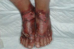 Patient #4. Pellagra affecting the upper surface of the feet. Note the erythematous eruption accompanied by considerable swelling, blisters, and erosions produced by the rupture of blisters.