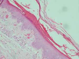 Patient #5. Histologic image showing parakeratotic hyperkeratosis together with a somewhat atrophic epidermis characterized by mild spongiosis, pallor, and ballooning. Dilated vessels with extravasation of red blood cells can be observed in the dermis (hematoxylin–eosin staining, original magnification ×200).