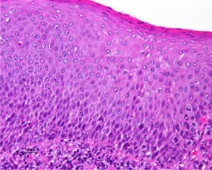 Hematoxylin–eosin, original magnification, ×200. Differentiated or simplex VIN. Dysmaturation in the lower third of the epidermis. Isolated mitoses. Associated parakeratosis.