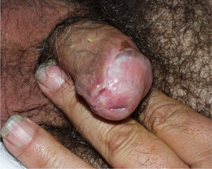 Penile squamous cell carcinoma on lichen sclerosus on the glans and balanoprepucial groove.