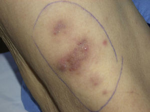 Firm plaques and nodules on the legs.