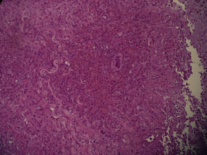 Suppurative granuloma due to mycobacterial infection.