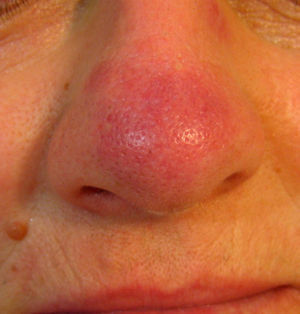 Erythematous–violaceous plaque on the dorsum of the nose.