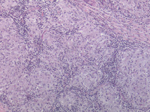 Sarcoid-type granulomatous inflammation (hematoxylin–eosin staining, original magnification ×10).
