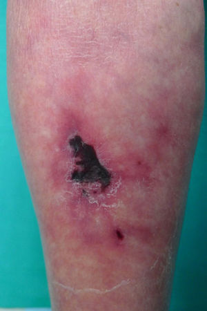 Ulcer with necrotic eschar surrounded by a reticular purpuric plaque on the back of the left leg.