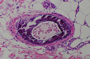 Skin biopsy showing intramural calcification and intimal hyperplasia in an arteriole of the subcutaneous tissue (hematoxylin–eosin, original magnification ×400).