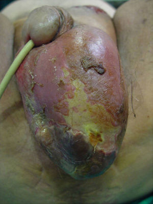 Characteristic necrotic plaques and blisters.