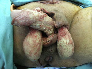 Exposure of the penis and testicles after extensive debridement. Healthy tissue is visible.
