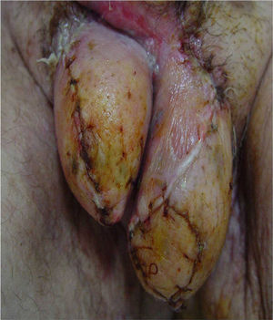 Reconstruction of the genital area and covering with skin after debridement.