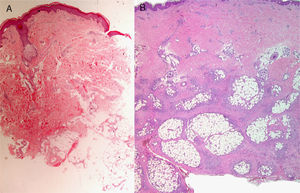 A, Hematoxylin–eosin, original magnification ×20. Suspected diagnosis, erythema nodosum. Slight perivascular lymphocytic infiltrate. Adipose tissue is scarce and a specific diagnosis cannot be made. B, Hematoxylin–eosin, original magnification ×40. Advanced erythema nodosum with septal panniculitis, granulomatous inflammation, and fibroplasia.