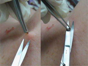 Scissors are used to make a tangential cut biopsy of a fibroma.