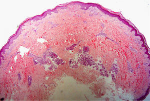 Hematoxylin–eosin, original magnification ×20. Epidermal and dermal necrosis with thrombi and parietal hyalinosis, findings compatible with a diagnosis of livedoid vasculopathy. Vessels at the dermal–hypodermal junction show foci of segmental fibrinoid necrosis indicating a diagnosis of polyarteritis nodosa.