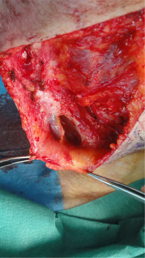 Exposed internal jugular vein during surgery to remove a cervical sentinel lymph node.