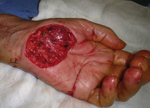 Exposure of the fascia covering the flexor tendons of the hand during excision of a melanoma.