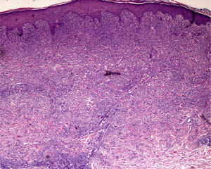 Hematoxylin–eosin, original magnification ×40. Incipient juvenile xanthogranuloma.
