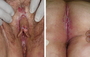 Vulva, showing numerous ulcers, fissures arranged longitudinally in the folds, and edema of the labia majora, labia minora, and clitoral hood. In the gluteal cleft, excrescent plaques with a pseudocondylomatous appearance and longitudinal cracks.
