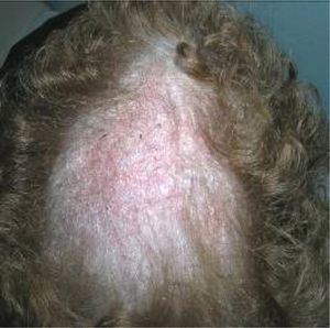 Case 1. Alopecic plaque with desquamation 3 months after onset.