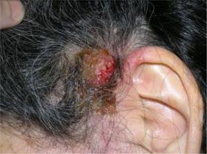 Case 4. Inflammatory, crusted plaque on the patient's scalp. Fungal culture was positive for Trichophyton mentagrophytes.