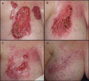 A, Two eroded giant basal cell carcinomas on the right side of the chest. B, Significant improvement in the lesions after 4 months of treatment with oral acitretin and imiquimod 5% cream. C, Reduction in the size of the tumor (70%) after 6 months. D, No signs of recurrence and acceptable cosmetic outcome 2 years after surgery.