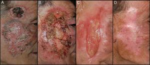 A, Ulcerated giant basal cell carcinoma on the right cheek and temple. B, Impetiginous exudative erythematous tumor plaque after application of topical imiquimod 5% combined with oral acitretin for 1 month. C, Granulation tissue after 2 months of local radiotherapy. D, Permanent resolution of the tumor at 15 months of follow-up.