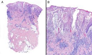 Biopsy of the edge of an ulcer diagnosed as pyoderma gangrenosum. A notable neutrophilic inflammatory infiltrate is visible in the upper dermis. A, Hematoxylin-eosin; original magnification ×4. B, Hematoxylin-eosin; original magnification ×10.