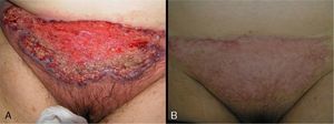 Appearance before (A) and after (B) treatment with oral prednisone.