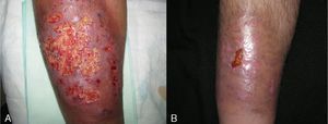 Appearance before (A) and after (B) treatment with adalimumab in combination with sulfasalazine in a patient with pyoderma gangrenosum and ankylosing spondylitis.