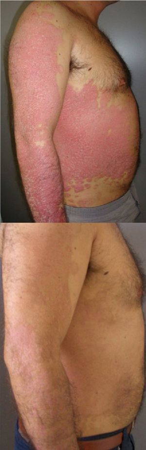Patient 1, who was treated with home phototherapy. A, Baseline (PASI 15.2). B, At 4 months (PASI 2.4).