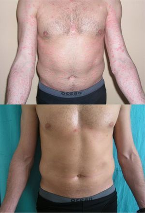 Patient 3, who was treated with home phototherapy. A, Baseline (PASI 11.4). B, At 4 months (PASI 1.2).