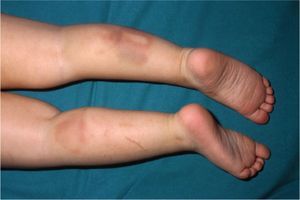 Bruises at different stages of healing; the linear shape is highly suggestive of physical abuse. (Photograph courtesy of Jordi Pou).