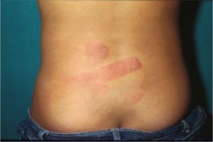 The back is a common location for the venting of frustration by child abuse perpetrators. (Photograph courtesy of Jordi Pou).