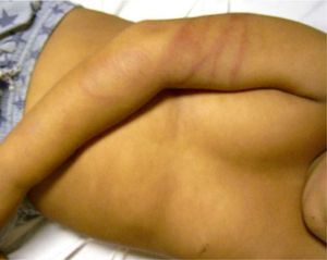Wraparound linear marks on the arms are characteristic signs of beating with a belt. (Photograph courtesy of Jordi Pou).