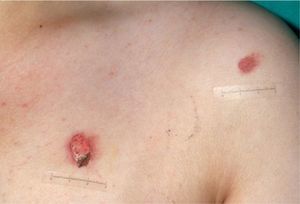 Cigarette burns are easy to identify and are occasionally associated with sexual abuse. (Photograph courtesy of Jordi Pou).