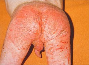 The diaper area is the most commonly affected area in cases of child neglect. (Photograph courtesy of Jordi Pou).