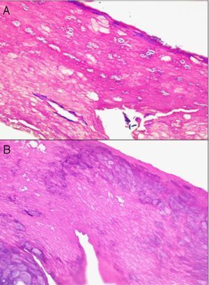 A, Hematoxylin–eosin, original magnification ×40. Fragment of the stratum corneum from the sole of the foot. (B) Gram staining revealed bacteria. Diagnosis: pitted keratolysis.