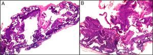 (A) Hematoxylin–eosin, original magnification ×100. Ballooning of cells caused by freezing and electrocauterization. (B) Elongated nuclei related to thermal damage from electrocauterization.