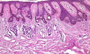 Ballooning (a freeze artifact) of melanocytes in a compound melanocytic nevus. Hematoxylin–eosin, original magnification ×40.