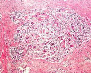 Foreign-body (suture) granuloma. Hematoxylin–eosin, original magnification ×100.