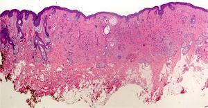 Desmoplastic trichoepithelioma. The cords of squamous cells that can be seen in the reticular dermis would make it difficult to rule out a sclerosing basal cell epithelioma in an incisional biopsy. Hematoxylin–eosin, original magnification ×20.