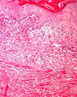 Small vessel leukocytoclastic vasculitis and incipient necrosis of the epidermis. Indirect immunofluorescence confirmed immunoglobulin A deposits, leading to a diagnosis of Henoch–Schönlein vasculitis.